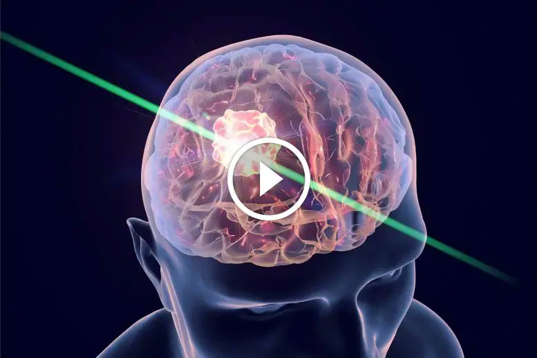 Moussasoft_com's tweet card. Signaux Quantiques - Une équipe de chercheurs de l'Université de Nottingham a découvert une méthode innovante pour cibler et éliminer les cellules cancéreuses dans les tumeurs cérébrales difficiles à...