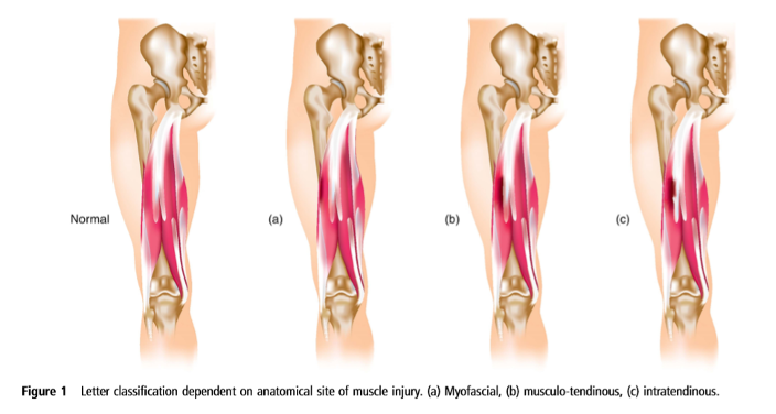 BJSM_BMJ's tweet card. Why develop a new muscle injury classification? The British Athletics Muscle Injury Classification (BAMIC) was developed in 2014 as part of a hamstring strategy.[1] An internal report in our elite...