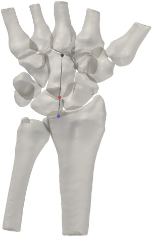 JHandSurg's tweet card. Scapholunate dissociation frequently results in malalignment and scapholunate advanced collapse (SLAC). Previous analyses have relied on visual observations of carpal angles among the scaphoid,...