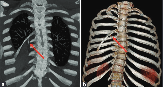 MarcGozlan's tweet card. C’est l’histoire d’une fillette de quatre ans qui présente une déformation du sternum qui a évolué depuis la naissance. L’examen clinique montre la présence d’une excroissance de 8 cm ayant une...