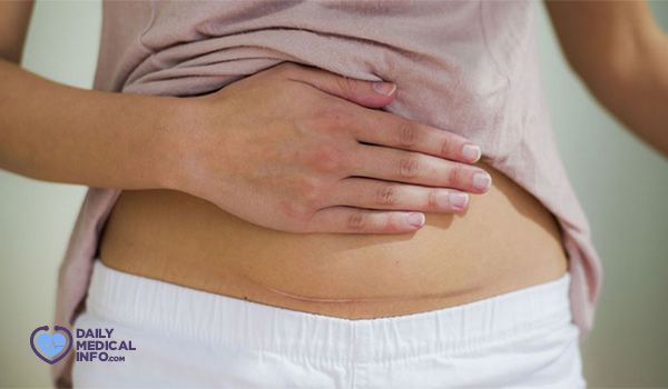 DMedicalinfo's tweet card. الشعور بألم العملية القيصرية بعد سنوات قد يكون نتيجة لإصابتك بتندب الأنسجة، اعرفي أكثر عن أعراض تندب الأنسجة وكيفية علاجع في هذا المقال.