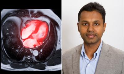 EuropHospital's tweet card. Researchers have developed a machine learning algorithm that uses cardiac MRI images to help identify breast cancer patients who may be at risk of cardiotoxicity during cancer treatment. The resear...