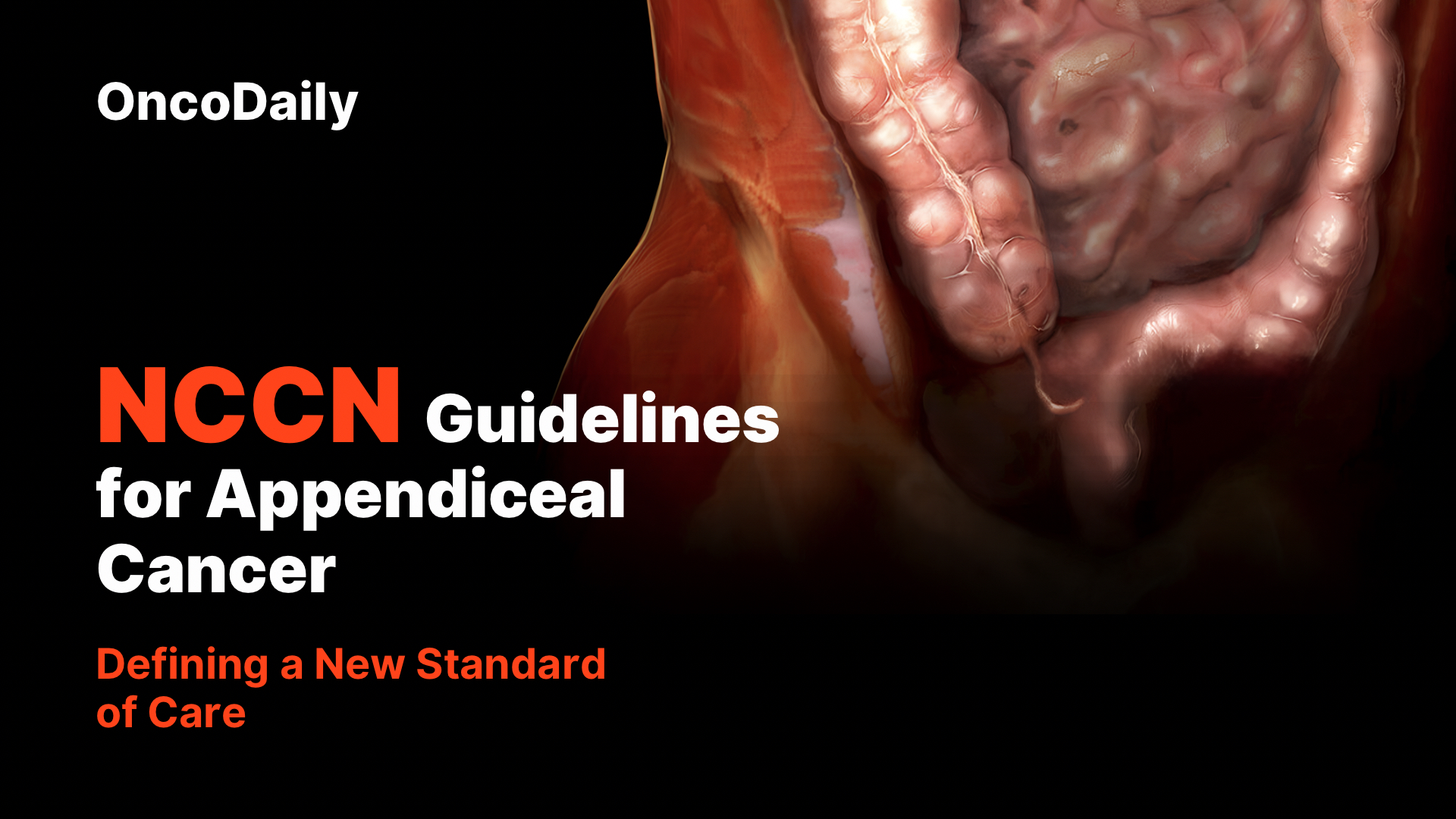 acpmpresearch's tweet card. NCCN Guidelines for Appendiceal Cancer: Defining a New Standard of Care 2025 / appendiceal cancer, cancer, Cancer Management, NCCN, NCCN guidelines, NCCN