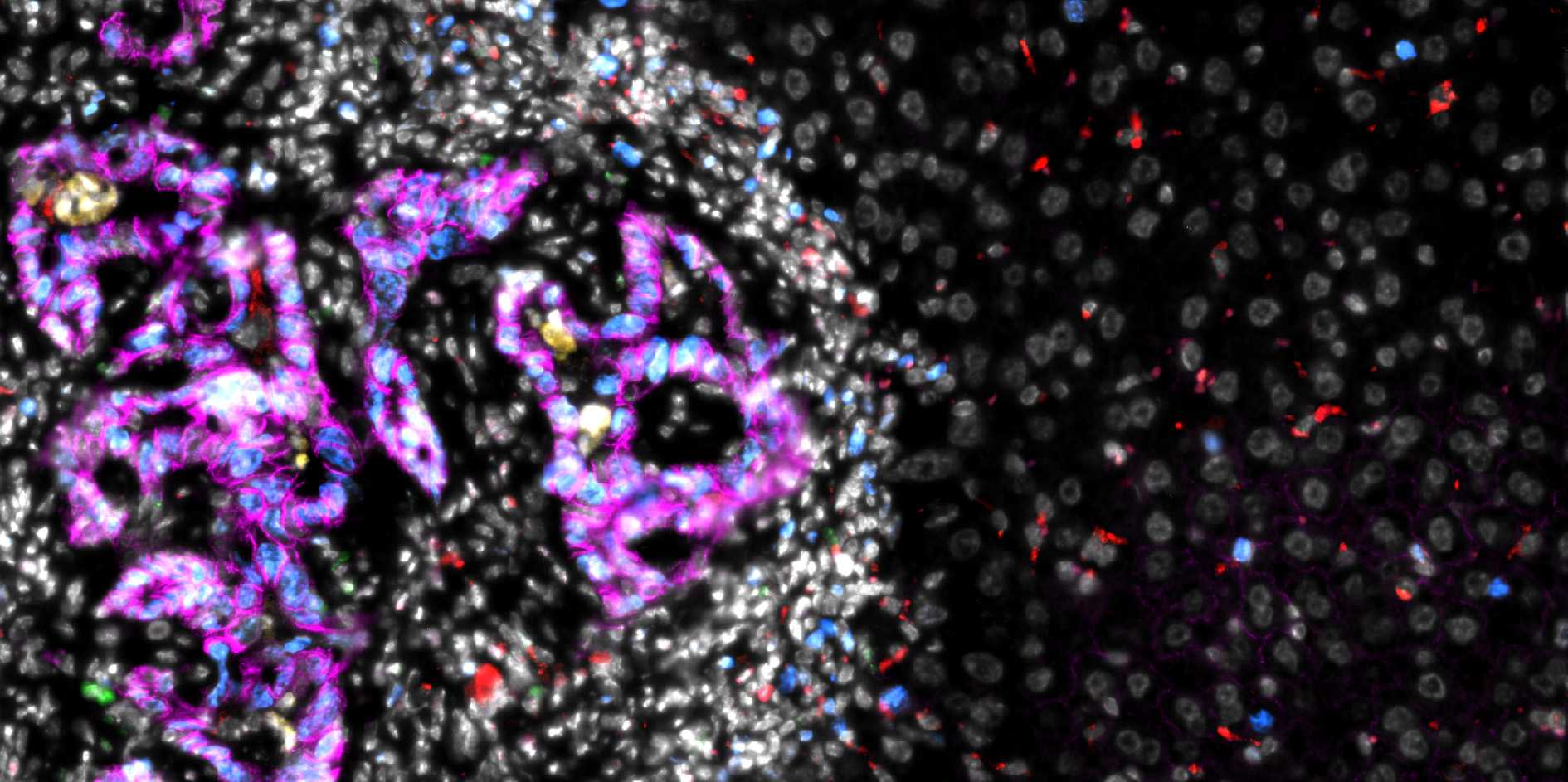 ETH_en's tweet card. Researchers at ETH Zurich have uncovered how colorectal cancer cells colonise the liver. Their findings could open up new ways to suppress this process in the future.