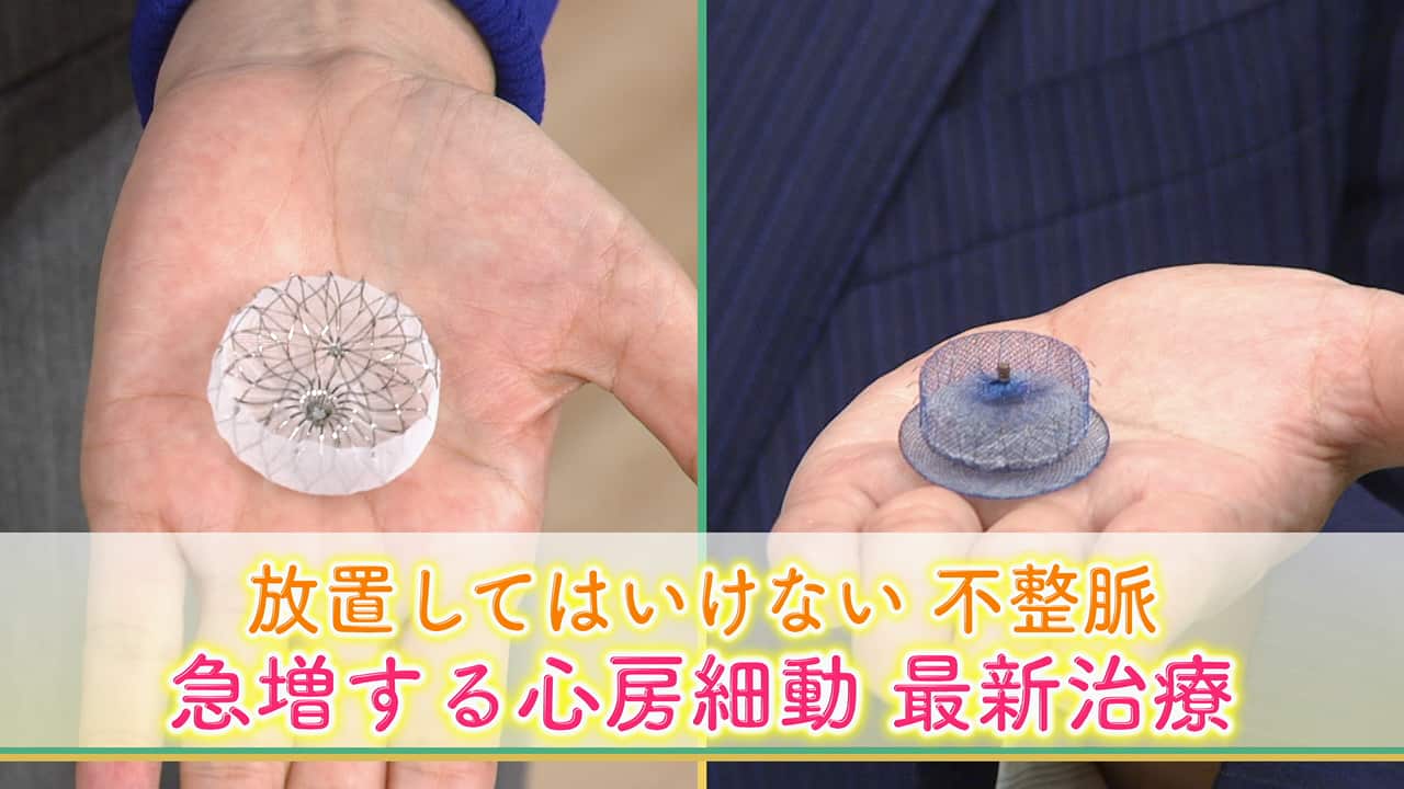 omron_hc_pr's tweet card. 【NHK】心房細動の治療として、心臓にカテーテルという管を送りこんで不整脈のもととなる部分の信号を断ち切る「カテーテルアブレーション」が広く行われるようになっている。また心房細動があると脳梗塞になりやすいため血栓ができるのを防ぐ抗凝固薬を使う必要があるが、出血リスクがあるため使えない場合も。最近は血栓が発生しやすい「左心耳」という部位にカテーテルで機器を送り込み留置する「左心耳閉鎖術」という...