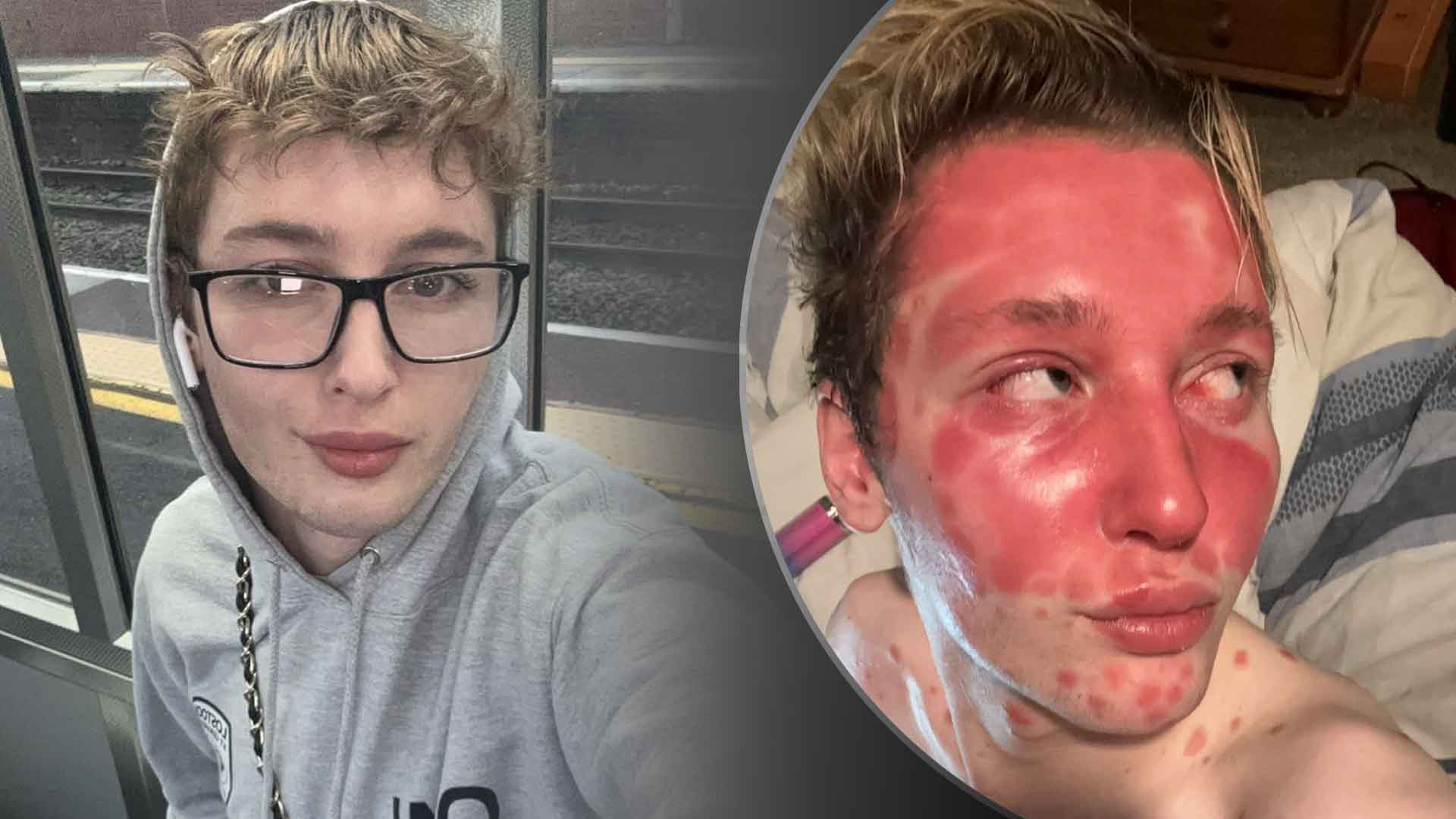 CoastalHMedia's tweet card. Influencer Charlie Michael Baker discusses his psoriasis journey after getting lip fillers at 16. Learn about risks and safety factors.