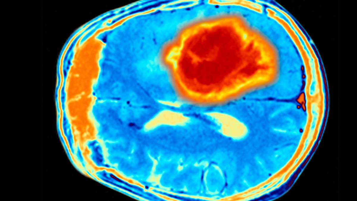 BrainTumourOrg's tweet card. Survival rates from one of the most common forms of brain tumour have risen sharply after surgical advances prompted a shift in how it is treated.Operating earlier to remove tumours has cut the...