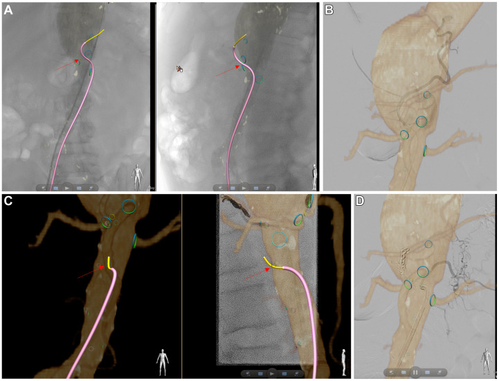JVascSurgCIT's tweet card. Branched/fenestrated endovascular aortic aneurysm repair (B/FEVAR) carries a risk of spinal cord ischemia (SCI), which increases along with increasing length of aortic luminal coverage of the repair....