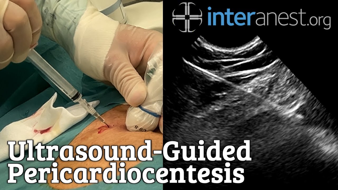 InterAnest's tweet card. Ultrasound-Guided Pericardiocentesis