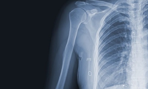 isciencejournal's tweet card. US researchers design a novel nanoparticle that could help cancer patients at risk for bone damage from radiation therapy