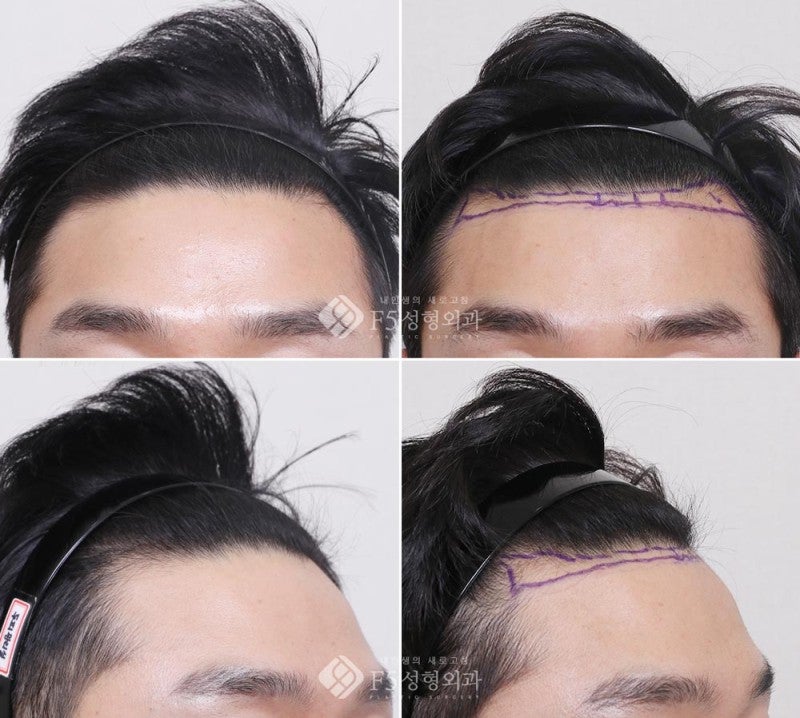 f5_scalp's tweet card.  こんにちは。F5頭皮クリニックのイ・サンジュン院長です。 本日は男性の方のヘアライン矯正術、植毛のデザインの症例を二つご紹介したいと思います。 額が広くてM…