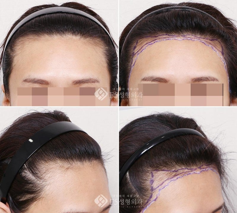 f5_scalp's tweet card.  こんにちは。F5頭皮クリニックのイ・サンジュン院長です。 本日はおでこが広いのが嫌でヘアライン矯正(ヘアライン植毛)を受けられた女性の患者様のデザイン症例を…