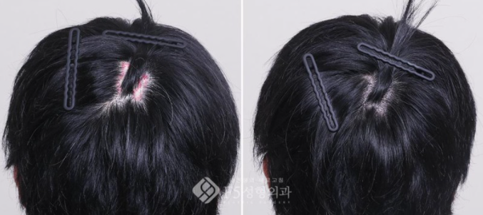 f5_scalp's tweet card.  こんにちは。F5頭皮クリニックのイ・サンジュン院長です。 本日は実際当院で頭皮の傷跡をカーバしたメディカル頭皮アートメイク(SMP)の症例をご紹介したいと思…