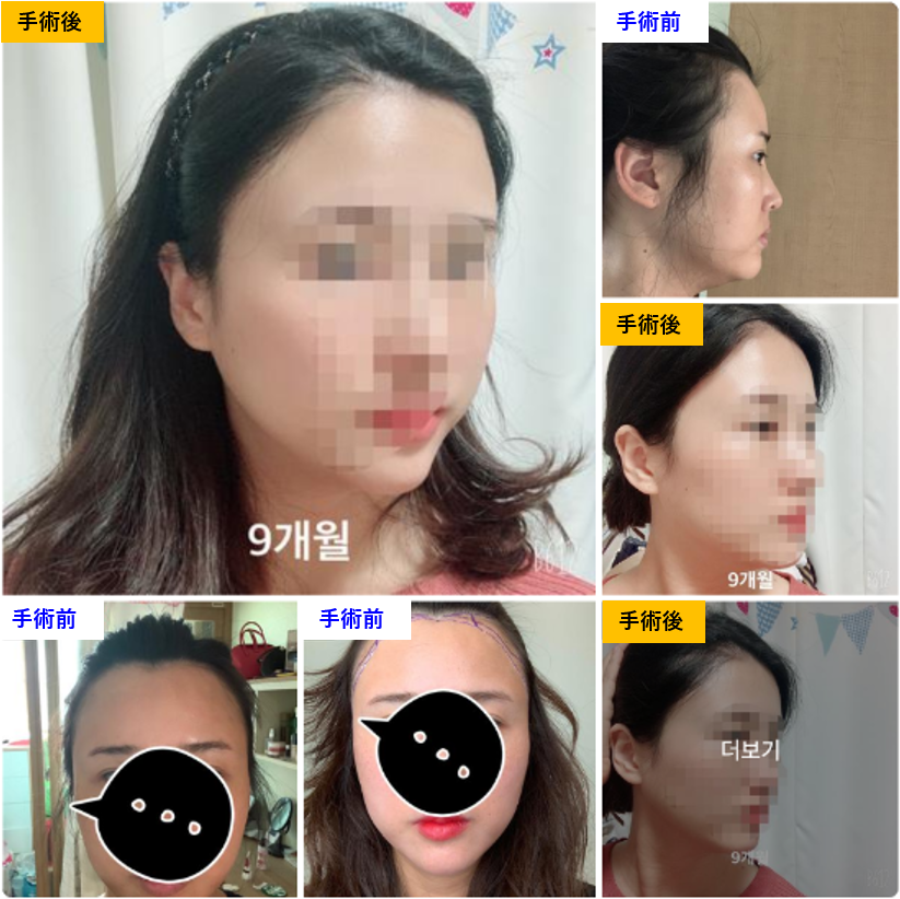 f5_scalp's tweet card.  こんにちは。F5頭皮クリニックのイ・サンジュン院長です。 本日は当院でヘアライン矯正術を受けられた患者様からのレポをご紹介します。  (術後の写真は9ヶ月目…