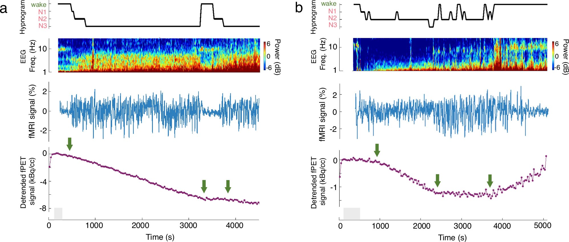 medical_xpress's tweet card. Nature Communications - Using simultaneous EEG-PET-MRI, this study reveals tightly coupled physiological dynamics during the descent from wakefulness into NREM sleep and identifies network-specific...