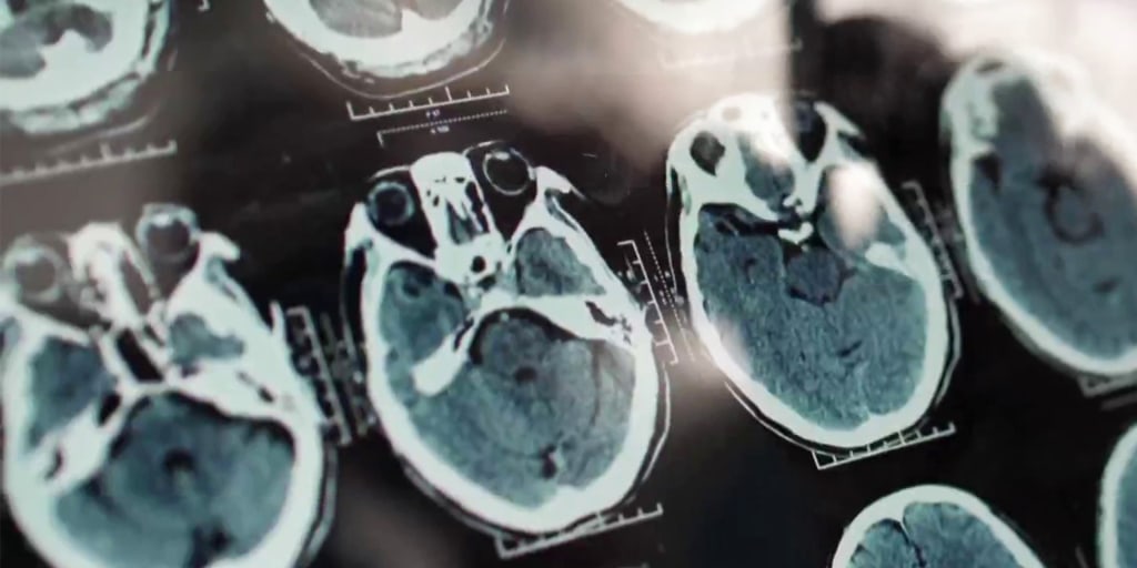 ADCSResearch's tweet card. Doctors say that once Alzheimer’s takes over the brain there’s little they can do to stop it, but if you catch it early there are medication and lifestyle changes that can help slow it down. Now, new...