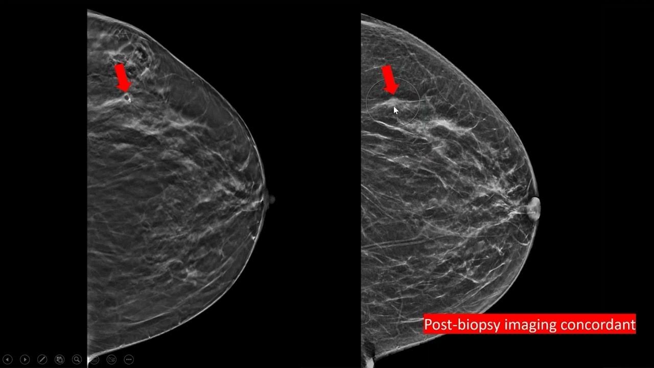 icadmed's tweet card. Chirag R. Parghi, MD - Case 1
