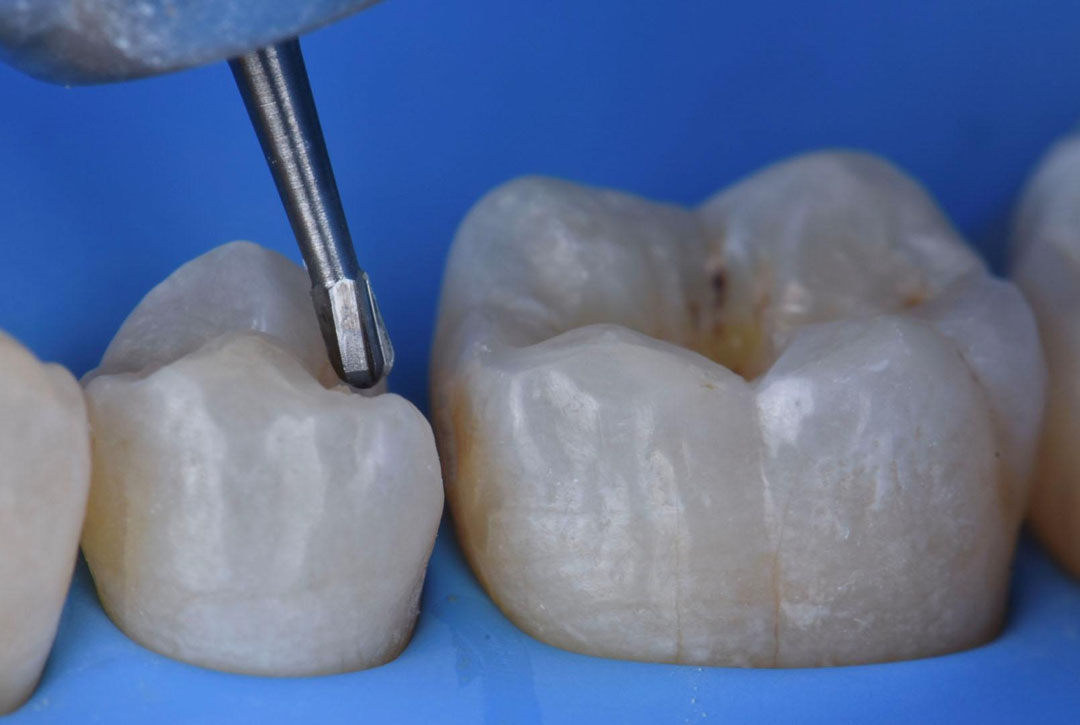 Aurelioralcare's tweet card. Discover how Dr. Tosco enhances posterior direct restorations with a highly efficient protocol inspired by the StyleItaliano philosophy, ensuring optimal function, esthetics, and long-term reliabil...