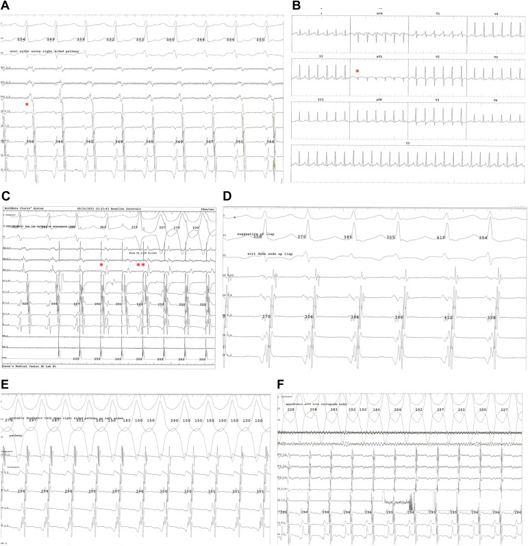 drdavidsingh's tweet card. Orthodromic atrioventricular reentrant tachycardia (AVRT), where the atrioventricular (AV) node serves as the anterograde limb and the accessory pathway serves as the retrograde limb, is the most...