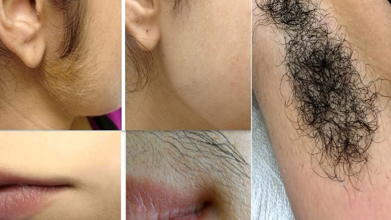 DBTipsOnline's tweet card. पुरे शरीर के अनचाहे बाल ऐसे खत्म हो जायेंगे की दोबारा नहीं आयेंगे ||...