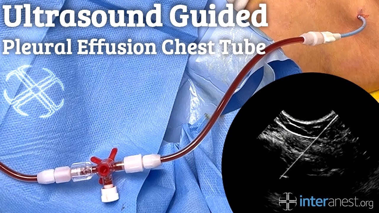 InterAnest's tweet card. Ultrasound guided Pleural Effusion Chest Tube