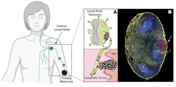 BellinzonaIrb's tweet card. Melanoma is the most lethal skin cancer, and its incidence, though low, has steadily increased over the last few years. During melanoma progression, tumor cells spread across the body via the...