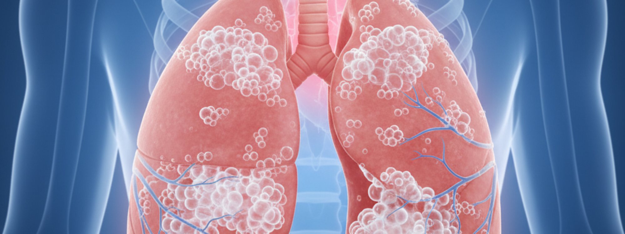 bbrian017's tweet card. Nov 07, 2025 - Health - Pulmonary edema is a serious health condition that involves the accumulation of fluid in the lungs, specifically within the extravascular space. This accumulation of fluid...