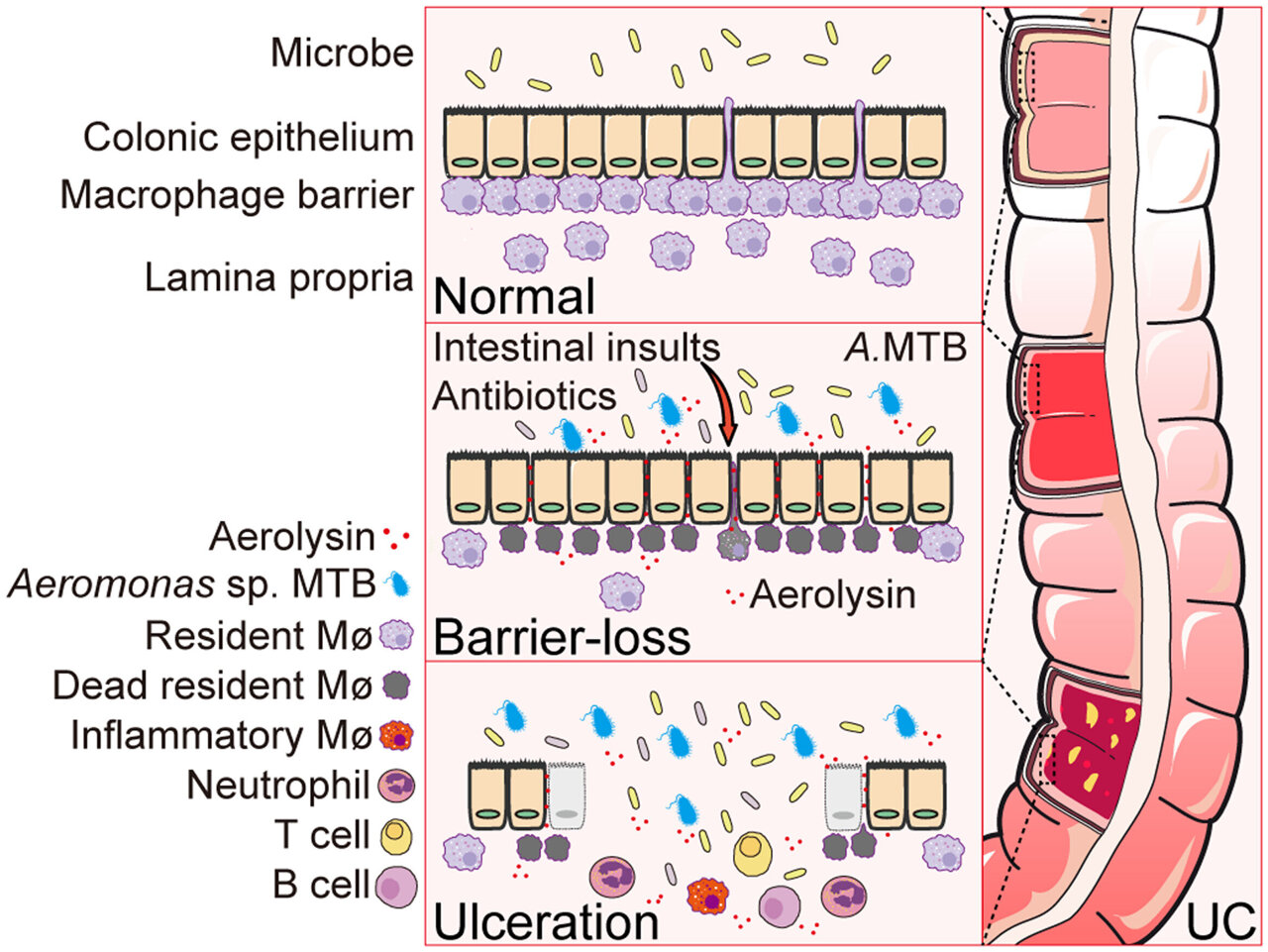 medical_xpress's tweet card. Ulcerative colitis (UC) is one of the most common inflammatory bowel diseases, a lifelong condition that can cause chronic inflammation and ulcers in the lining of the large intestine. This can lead...