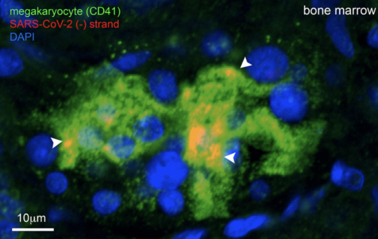 polybioRF's tweet card. Project summary:The project will determine if replication-competent SARS-CoV-2 virus can be identified in the megakaryocytes (bone marrow-derived cells) and platelets of...