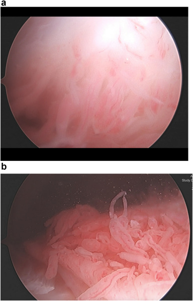 DocMatzkin's tweet card. Although degenerative meniscal tear is relatively prevalent in older persons, the sources of the accompanying pain and mechanical symptoms—such as knee clicking, locking, and popping—are unclear,...