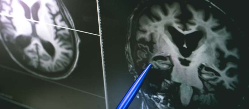 RareDisease_Adv's tweet card. Patients with SCD may have much higher cerebral blood flow than healthy controls, along with slower thinking and increased pain sensitivity.