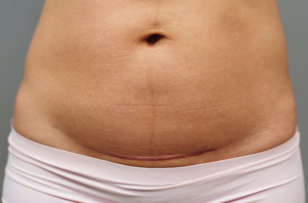 growingyourbaby's tweet card. New findings show that when cesarean scars form near the cervix, they may lead to symptoms like spotting, discomfort, and even complications in later pregnancies.