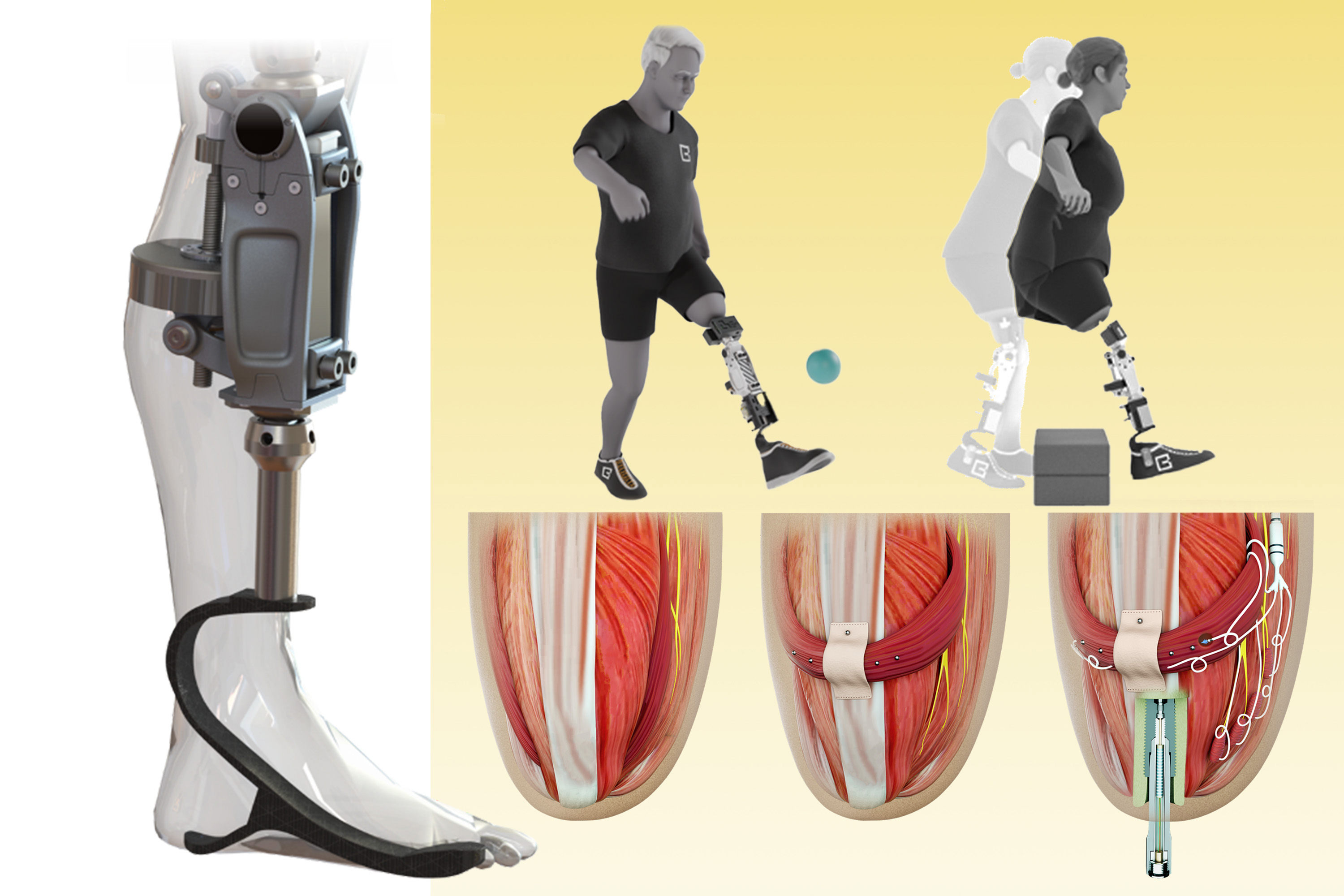 smaksked's tweet card. MIT researchers developed a new type of bionic knee that can help people with above-the-knee amputations walk faster, climb stairs, and avoid obstacles more easily than they could with a traditional...