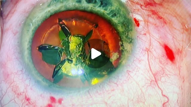 profluigimarino's tweet card. Luigi Marino MD PhD (@profluigimarino) • Instagram video