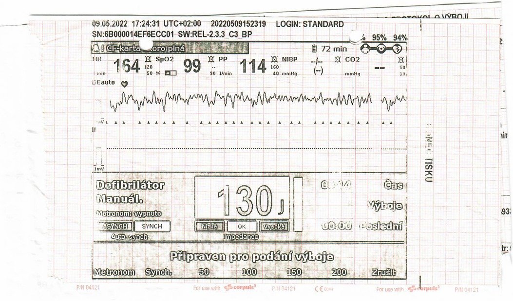 ASPNeph's tweet card. Salt-losing tubulopathies are well-recognised diseases predisposing to metabolic disturbances in affected patients. One of the most severe complications can ...