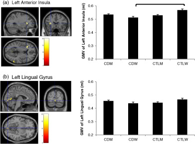 AddictionEnigma's tweet card. Given the variability of gray matter volume (GMV) in select brain areas between men and women, we used voxel-based morphometry data derived from the ENIGMA Addiction Consortium to investigate...