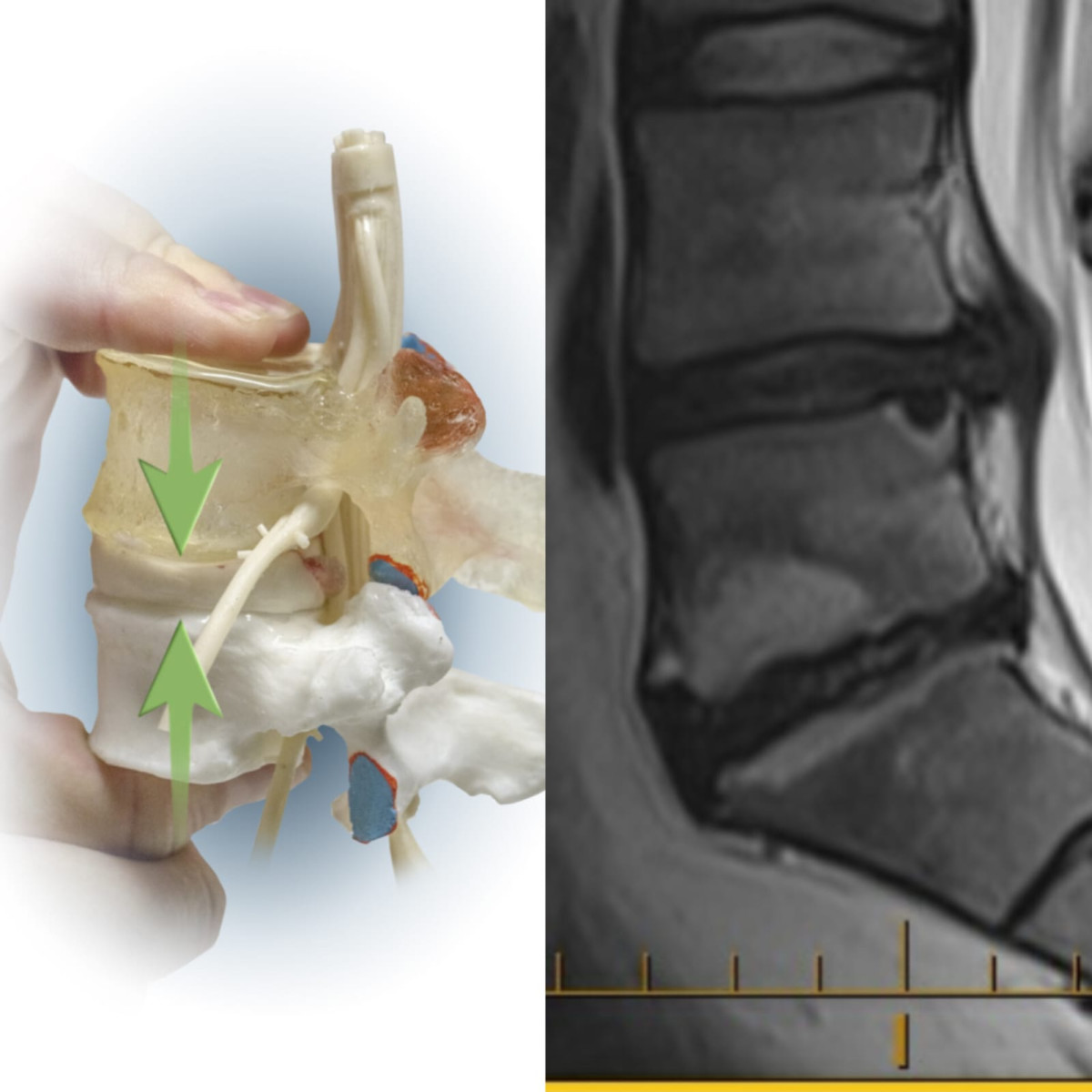 dynamicdisc's tweet card. Discover how upright spinal MRI reveals posture-dependent disc herniations that are often missed in traditional scans. Learn how Dynamic Disc Models visually demonstrate these real-time spinal...