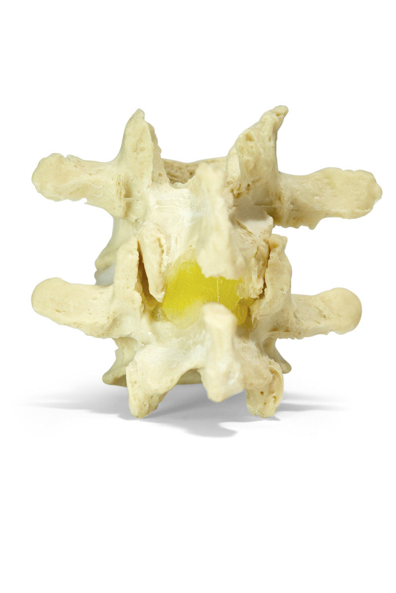 dynamicdisc's tweet card. Digital pain diagrams reveal consistent lumbar spinal stenosis pain patterns. Help patients visualize their symptoms using dynamic spine models from ddd.