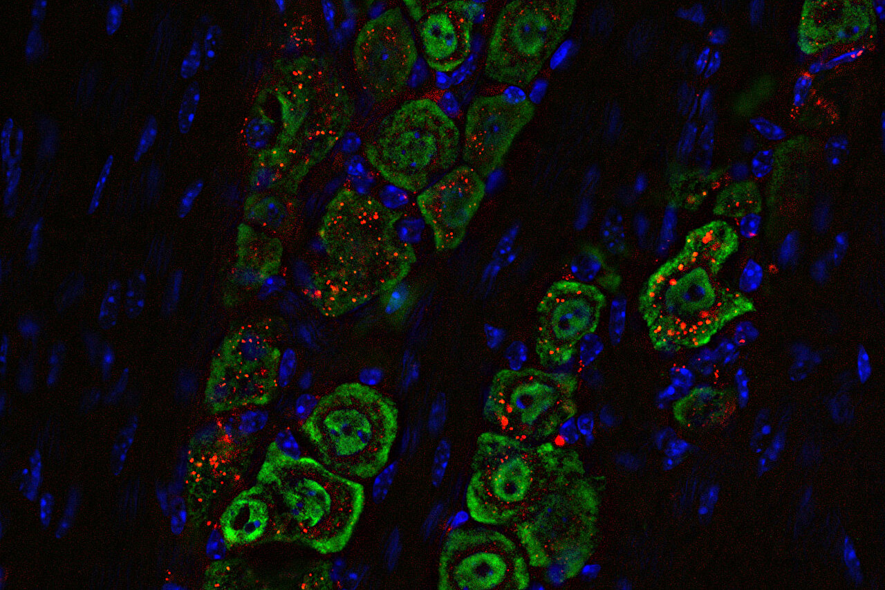 medical_xpress's tweet card. Researchers at Washington University School of Medicine in St. Louis, along with collaborators at Northwestern University, have developed a noninvasive approach to treat one of the most aggressive...