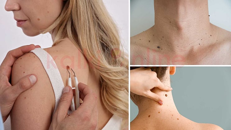 KalkiOnline's tweet card. நமது அழகை எடுத்துக்காட்டுவது பெரும்பாலும் நம் உடலை மூடி இருக்கும் வெளிப்புற சரும அமைப்பே ஆகும். அந்த சரும நிறம் மாறினாலோ அல்லது அதில் மருக்கள், மச்சங்கள் போன்றவ