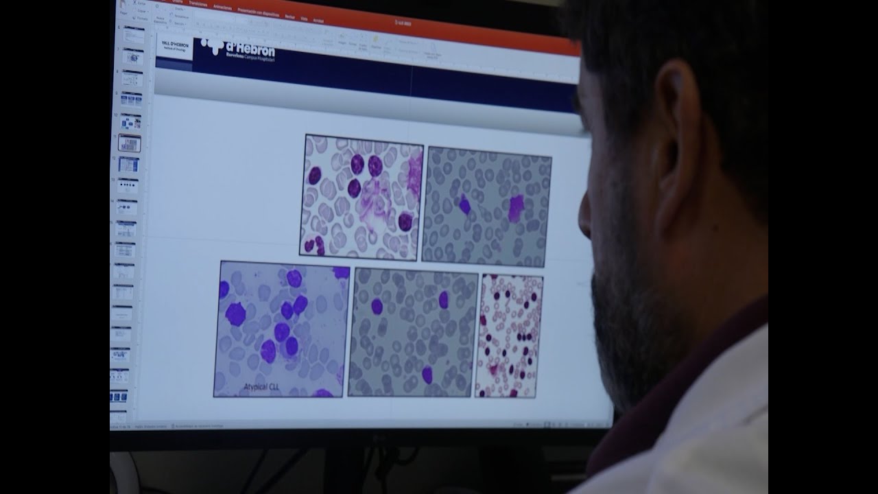 AstraZenecaES's tweet card. Percepción sobre los tumores hematológicos en España