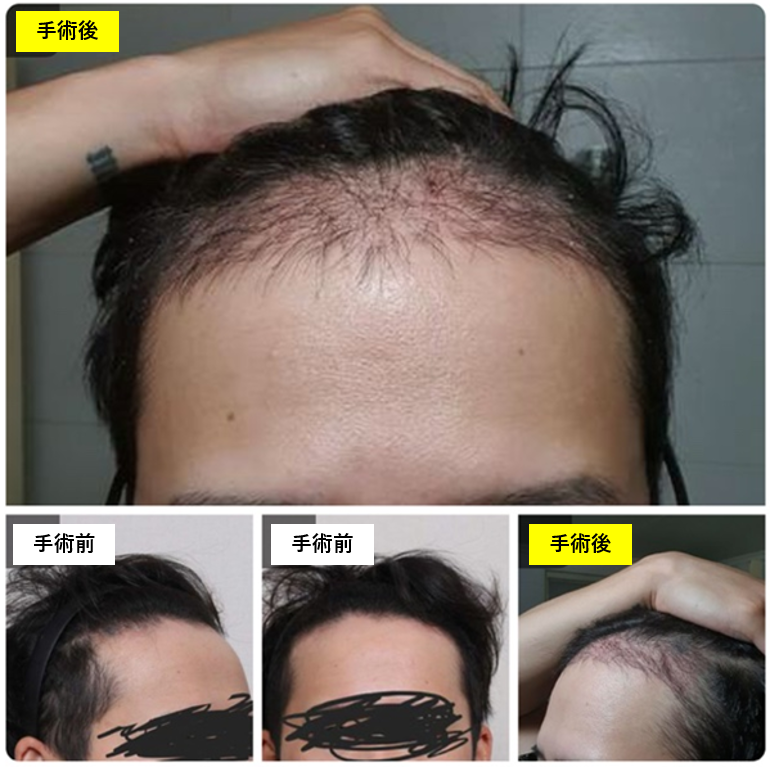 f5_scalp's tweet card.  こんにちは。F5頭皮クリニックです 本日は当院でヘアライン矯正術を受けられた患者様より書いて頂いた手術レポをご紹介したいと思います。     ヘアライン矯正…