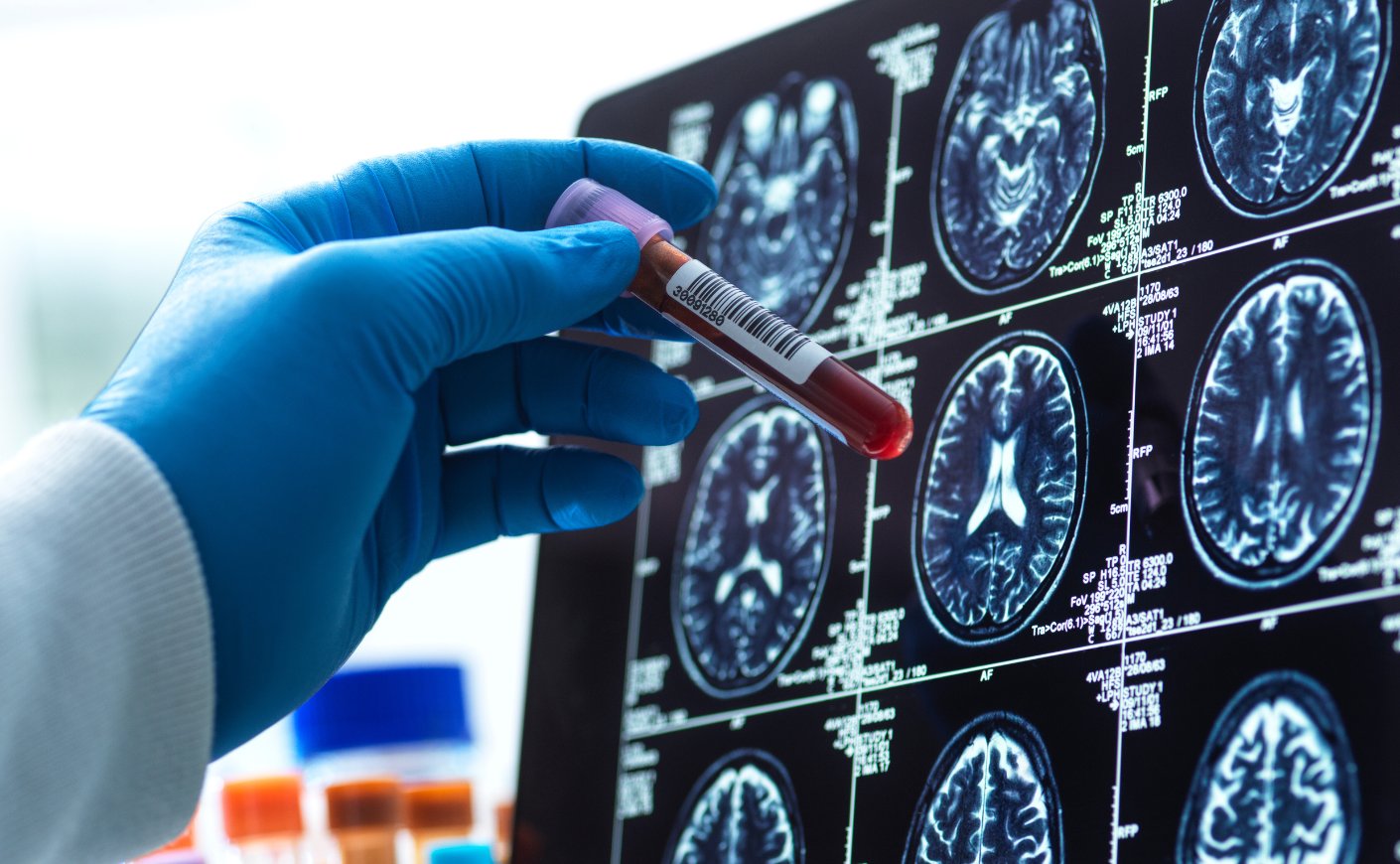 alzassociation's tweet card. An expert breaks it all down.