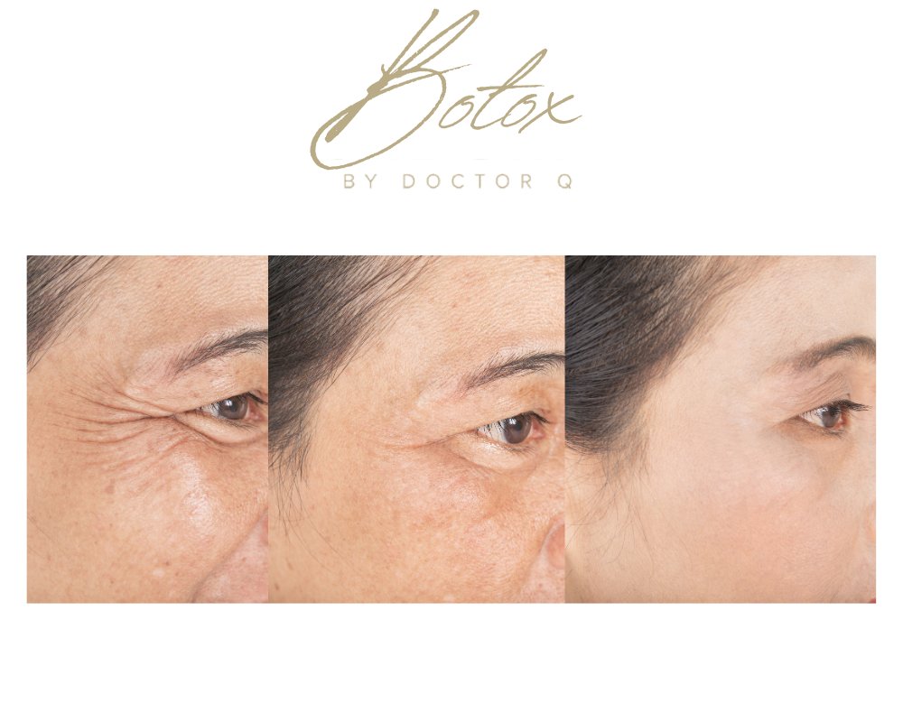 Valextino's tweet card. Looking for Botox in Glasgow? Luxe Skin offers expert and high quality Botox Treatments performed exclusively by Doctor Q.