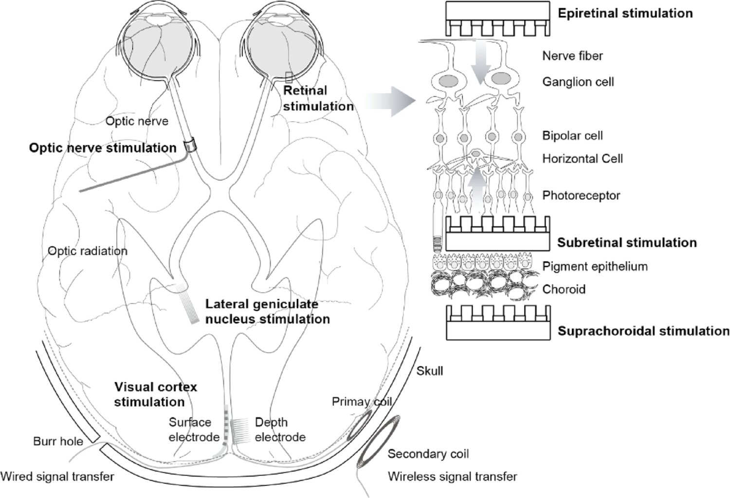 seeingwithsound's tweet card. Biomedical Engineering Letters - This review article focuses on recent advancements and persistent challenges in artificial vision prostheses designed to restore sight for patients affected by...