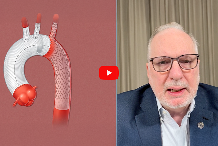 VascularNews's tweet card. Joseph Bavaria (Jefferson Health, Philadelphia, USA) speaks to Vascular News about a technique he says offers a “complete and total thoracic solution” for acute dissections, chronic dissections, and...