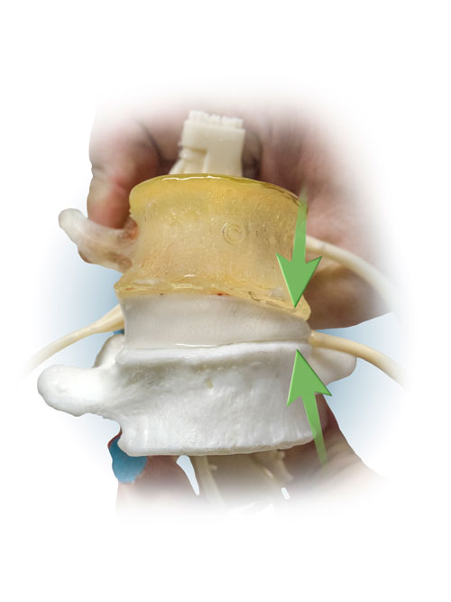 dynamicdisc's tweet card. New research shows that daily uneven loading affects disc cell health. Learn how ddd models help explain spine asymmetry and degeneration.