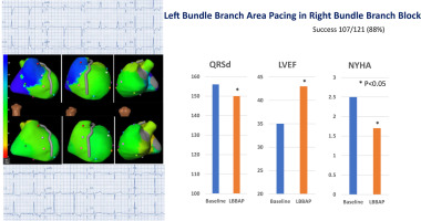 HRS_O2Journal's tweet card. Cardiac resynchronization therapy (CRT) using biventricular pacing has limited efficacy in patients with heart failure (HF) and right bundle branch block (RBBB). Left bundle branch area pacing...