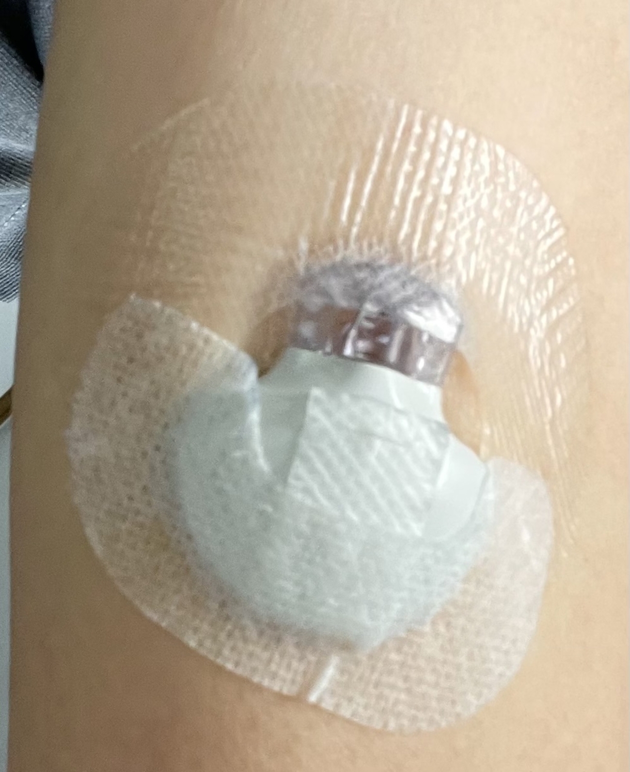 toshi_idmm's tweet card. 7/24 追記（延長使用の記録） 780Gを使い始めてから１年５ヵ月になる。当初はいろいろ模索したが、自分なりの使い方に落ち着き、QOLが改善している。 その中で、CGMセンサの扱い（較正の必要性とタイミングなど）で試行錯誤したが、今はルーチン化した。これについて記事にまとめる。 なお、私はセンサを７日間の期限を延長し…