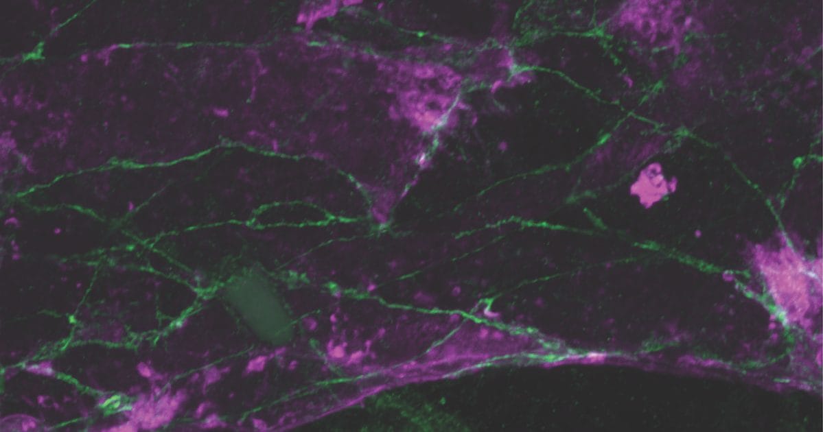 CaronLabUNC's tweet card. A new cell and animal study highlights reduced lymphatic vessel permeability in the meninges as a novel mechanism underlying migraine.